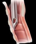 Parker 20 Fr Nasopharyngeal Airway with Flex-Tip