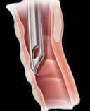 Cuffed Endotracheal Tube Flex-Tip® Curved 7.0 mm Adult Murphy Eye - H-PFHV-70-10