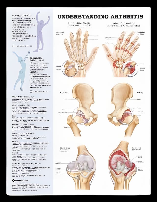 Anatomical Chart Arthritis 20 X 26 Inch Heavy Paper Grommets Laminated