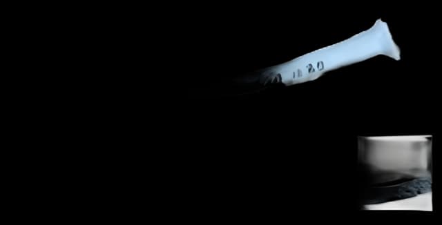 Nasopharyngeal Airway Set Sun Med 20 Fr. to 36 Fr.